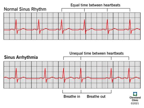 Normal sinus rhythm and sinus arrhythmia .